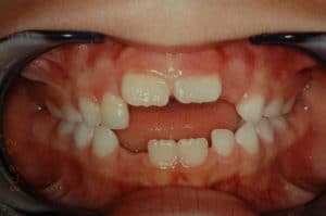 Les dents de Dorren au début du traitement OSB.