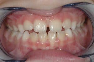 Les dents d'Alexandre au début du traitement OSB.