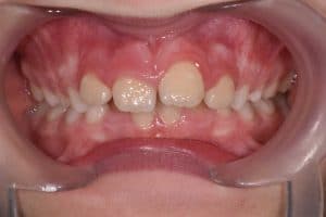 Les dents de Charline au début du traitement OSB.