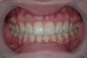 Les dents de Dorren à la fin du traitement OSB.
