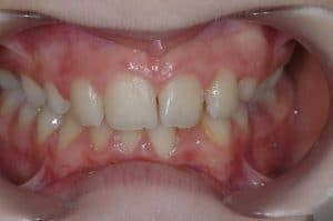 Les dents de Maelle au début du traitement OSB.