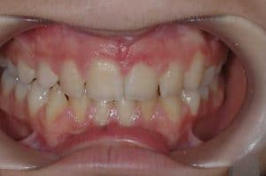 Les dents de Maelle après un an de traitement OSB.