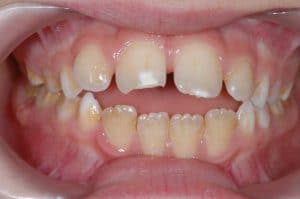 Les dents de Victor au début du traitement OSB.