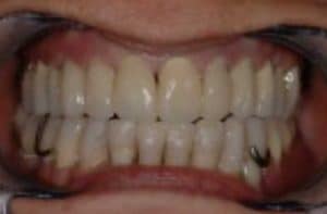Les dents de Marie-France après 6 mois de traitement.